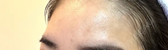 ボトックス（額） TCB東京中央美容外科 岡山院 DAY 8 メイン用