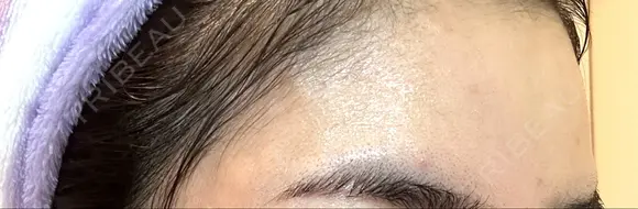 ボトックス（額） TCB東京中央美容外科 岡山院 DAY 8 メイン用