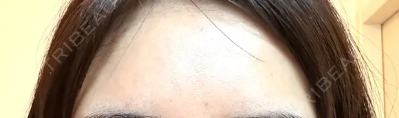 ボトックス（額） TCB東京中央美容外科 岡山院 DAY 9 メイン用
