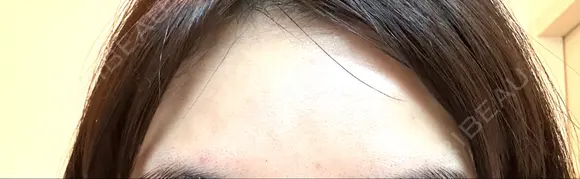 ボトックス（額） TCB東京中央美容外科 岡山院 DAY 9 メイン用