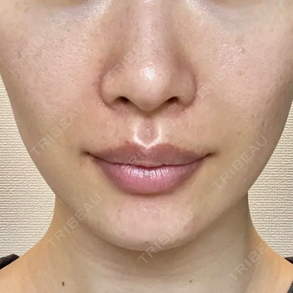 ヒアルロン酸注入（あご） / ヒアルロン酸注入（鼻翼基部） HAAB×DREAM BEAUTY CLINIC 東京本院 DAY 2 メイン用