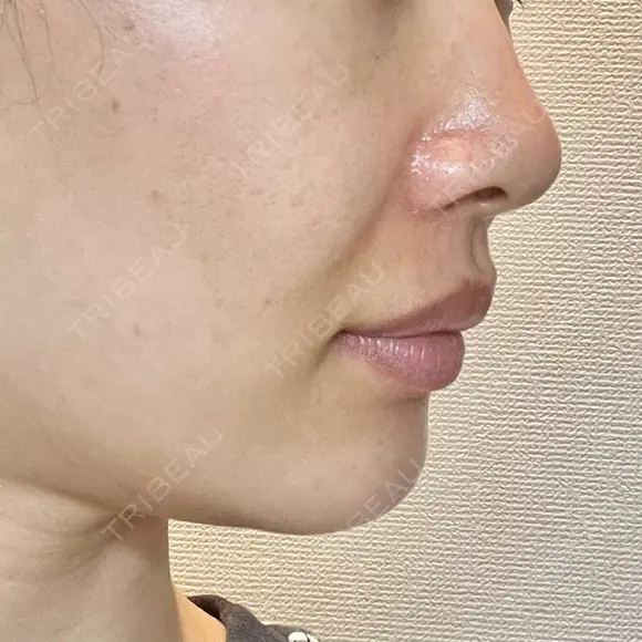 ヒアルロン酸注入（あご） / ヒアルロン酸注入（鼻翼基部） HAAB×DREAM BEAUTY CLINIC 東京本院 DAY 2 メイン用