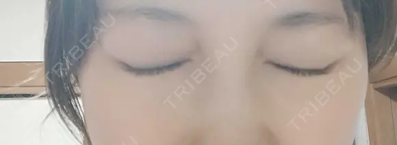 ボトックス（眉間） 湘南美容クリニック 本厚木院 DAY 7 メイン用
