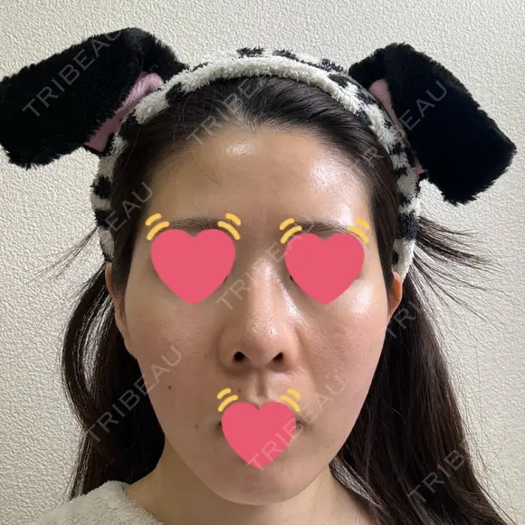 隆鼻術 / 鼻中隔延長（切開） / 鼻翼基部形成（貴族手術） ヴェリテクリニック 銀座院 DAY 70 メイン用