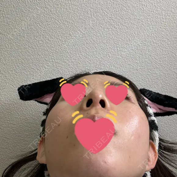 隆鼻術 / 鼻中隔延長（切開） / 鼻翼基部形成（貴族手術） ヴェリテクリニック 銀座院 DAY 70 メイン用