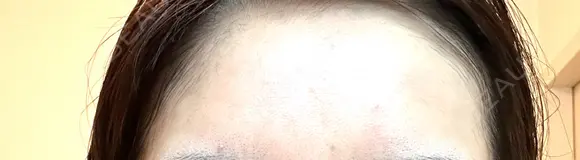 ボトックス（額） TCB東京中央美容外科 岡山院 AFTER メイン用