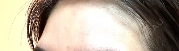 ボトックス（額） TCB東京中央美容外科 岡山院 DAY 14 メイン用