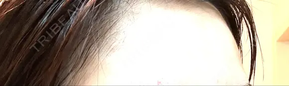 ボトックス（額） TCB東京中央美容外科 岡山院 DAY 14 メイン用