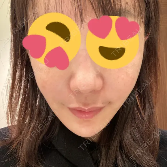 糸リフト / 脂肪吸引（顔） / ボトックス（エラ・小顔） / ヒアルロン酸注入（頬） Tokyo Tensei Clinic 新宿院 DAY 47 メイン用