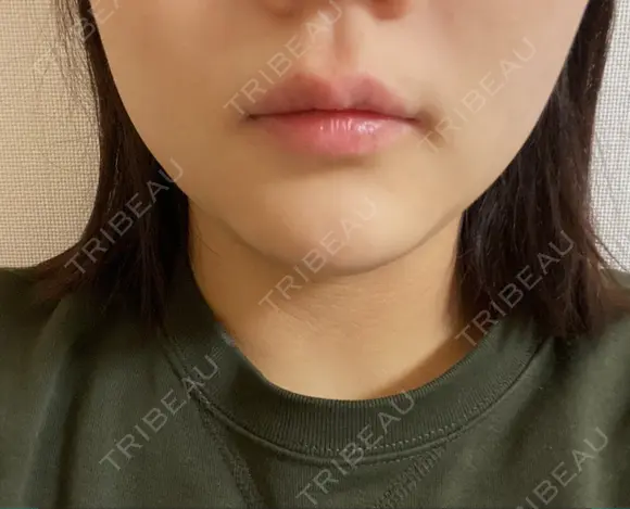 ボトックス（エラ・小顔） TCB東京中央美容外科 京都駅前院 DAY 15 メイン用