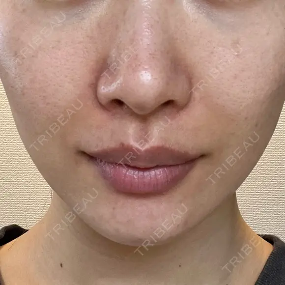 ヒアルロン酸注入（あご） / ヒアルロン酸注入（鼻翼基部） HAAB×DREAM BEAUTY CLINIC 東京本院 AFTER メイン用