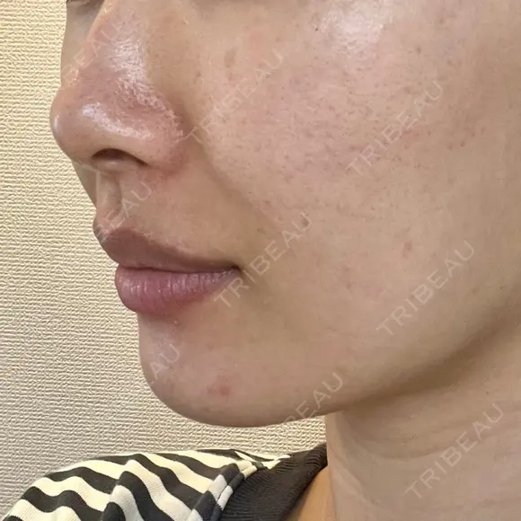 ヒアルロン酸注入（あご） / ヒアルロン酸注入（鼻翼基部） HAAB×DREAM BEAUTY CLINIC 東京本院 DAY 3 メイン用