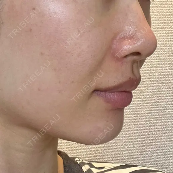ヒアルロン酸注入（あご） / ヒアルロン酸注入（鼻翼基部） HAAB×DREAM BEAUTY CLINIC 東京本院 DAY 3 メイン用