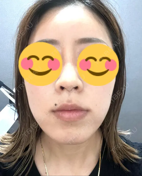 ハイフ（顔） 東京美容外科 熊本院 DAY 11 メイン用