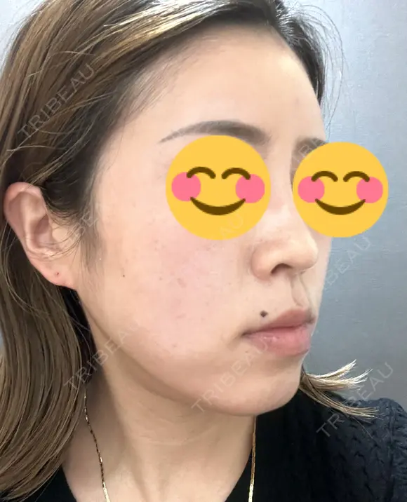 ハイフ（顔） 東京美容外科 熊本院 DAY 11 メイン用