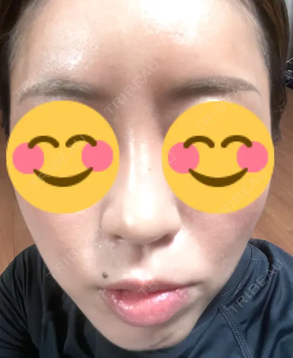 ハイフ（顔） 東京美容外科 熊本院 DAY 10 メイン用