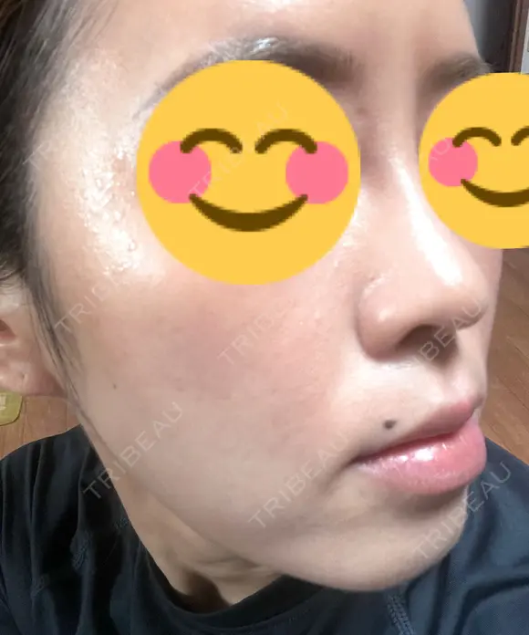 ハイフ（顔） 東京美容外科 熊本院 DAY 10 メイン用