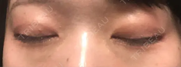 二重埋没 TCB東京中央美容外科 青森院 DAY 145 メイン用