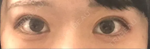 二重埋没 TCB東京中央美容外科 青森院 AFTER メイン用