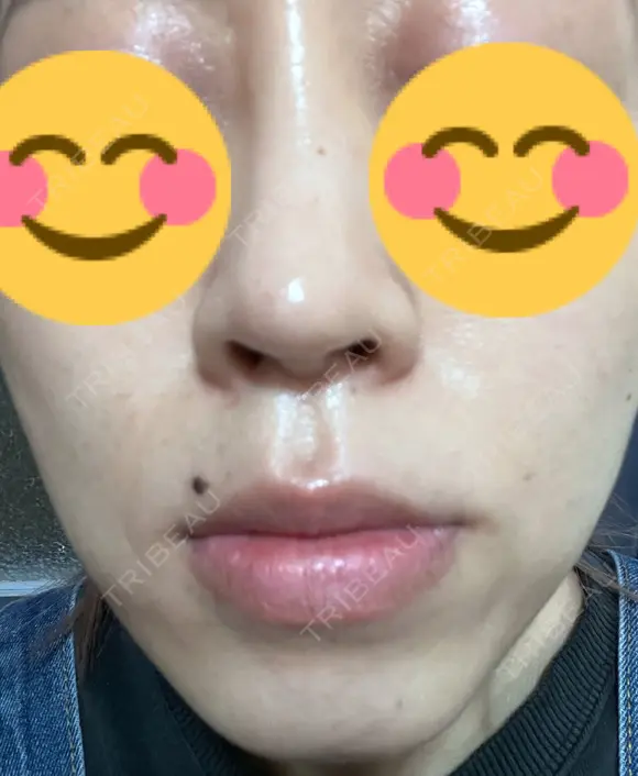ハイフ（顔） 東京美容外科 熊本院 AFTER メイン用