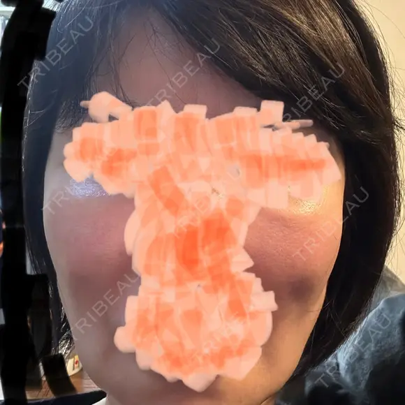 骨削り（エラ） / 骨削り（頬） ボンディ美容整形外科（旧リオン整形外科） DAY 20 メイン用