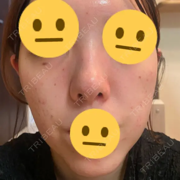 脂肪溶解注射（顔） / シワ取りボトックス / ボトックス（眉間） / ボトックス（目尻） TCB東京中央美容外科 梅田茶屋町院 DAY 4 メイン用