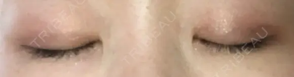 二重埋没 湘南美容クリニック 松山院 DAY 28 メイン用