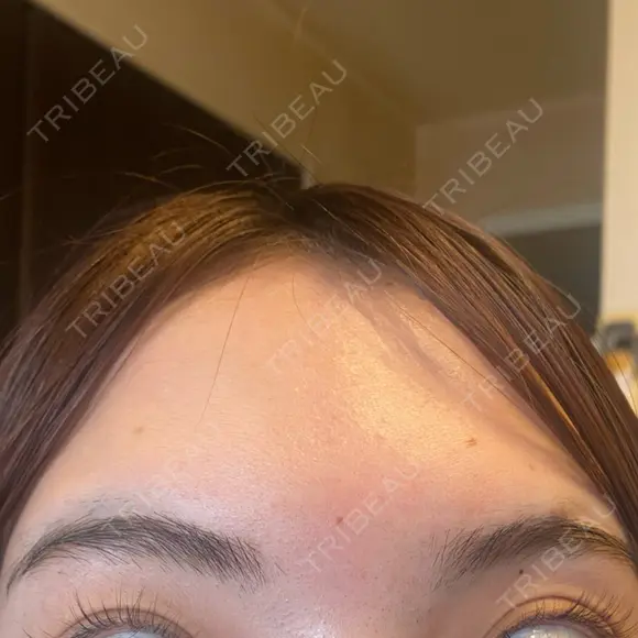 脂肪溶解注射（顔） / シワ取りボトックス / ボトックス（眉間） / ボトックス（目尻） TCB東京中央美容外科 梅田茶屋町院 DAY 4 メイン用