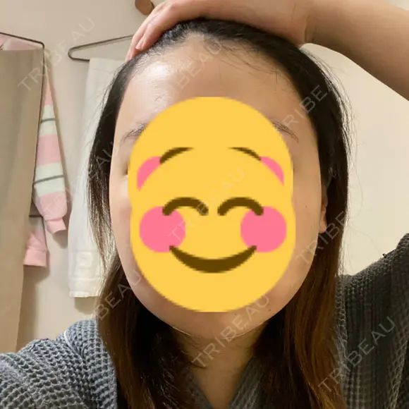 骨削り（エラ） / 脂肪吸引（顔） id（アイディ）美容外科 DAY 1 メイン用