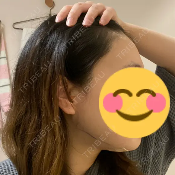 骨削り（エラ） / 脂肪吸引（顔） id（アイディ）美容外科 DAY 1 メイン用