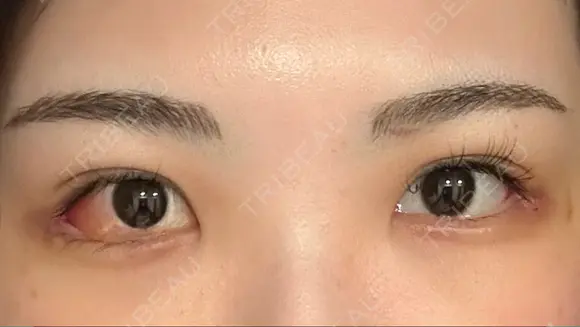 目尻切開 / 目尻靭帯移動 S.T styleクリニック DAY 8 メイン用