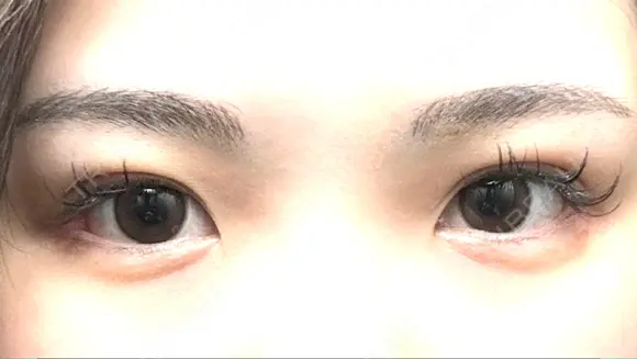 目尻切開 / 目尻靭帯移動 S.T styleクリニック AFTER メイン用