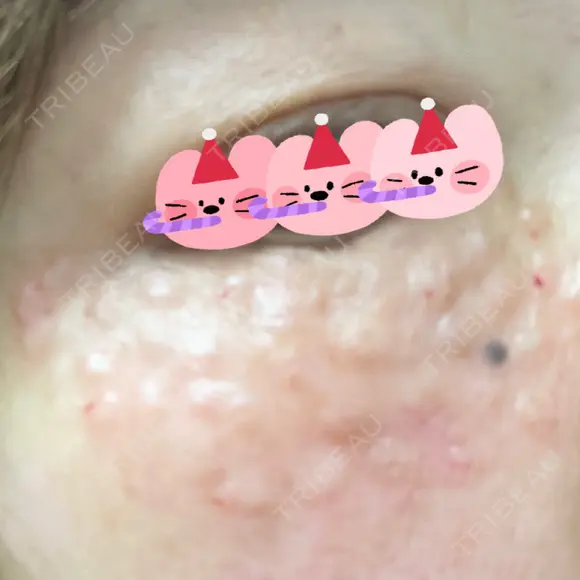 リジュラン 東京ココセランクリニック AFTER メイン用