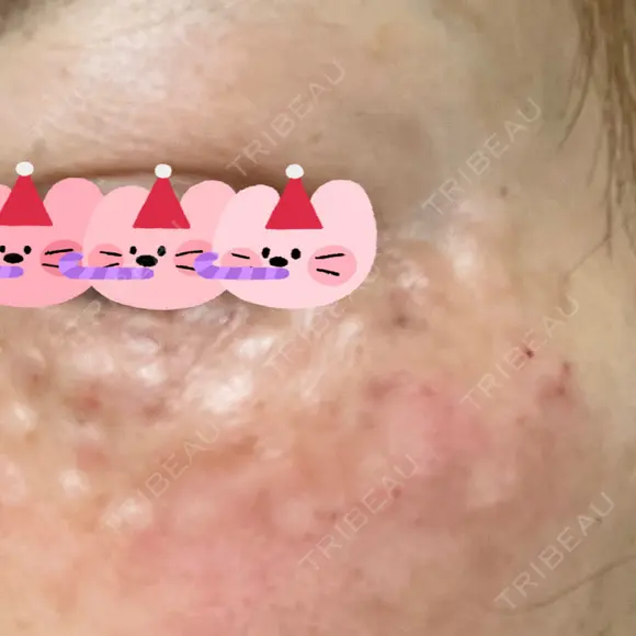 リジュラン 東京ココセランクリニック DAY 0 メイン用