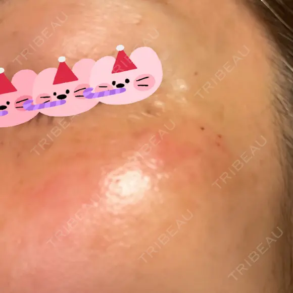 リジュラン 東京ココセランクリニック DAY 0 メイン用