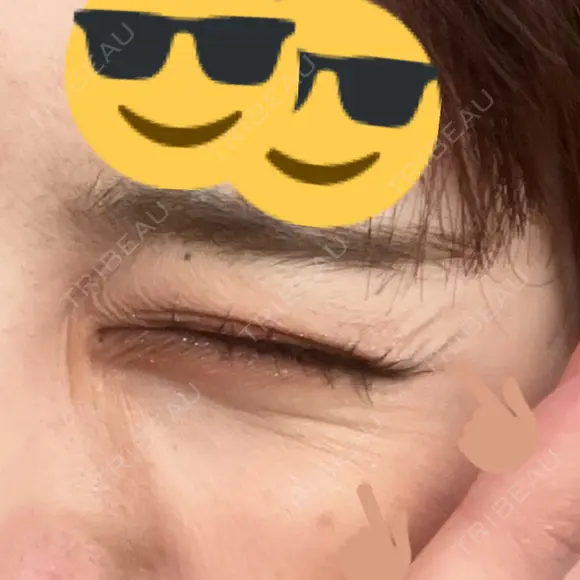 脂肪溶解注射（顔） / シワ取りボトックス / ボトックス（眉間） / ボトックス（目尻） TCB東京中央美容外科 梅田茶屋町院 DAY 5 メイン用