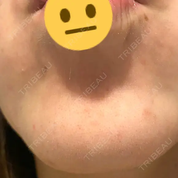 脂肪溶解注射（顔） / シワ取りボトックス / ボトックス（眉間） / ボトックス（目尻） TCB東京中央美容外科 梅田茶屋町院 DAY 5 メイン用