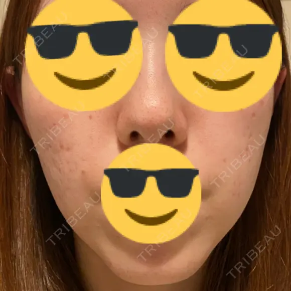 脂肪溶解注射（顔） / シワ取りボトックス / ボトックス（眉間） / ボトックス（目尻） TCB東京中央美容外科 梅田茶屋町院 DAY 5 メイン用