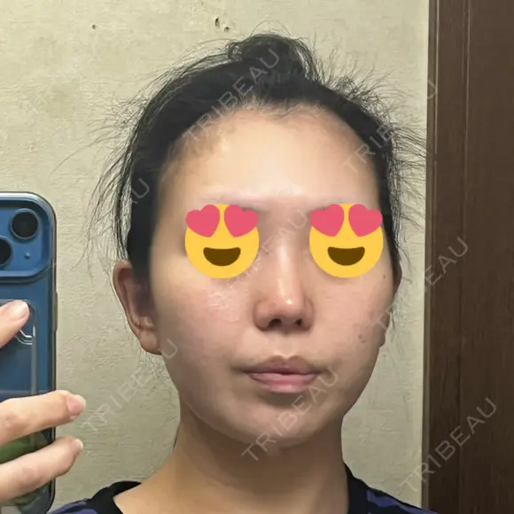 鼻尖形成（切開） / 小鼻縮小（切開） / 脂肪吸引（顔） / 軟骨移植 / 骨切幅寄せ / 鼻尖縮小 / 鼻柱挙上 銀座マイアミ美容外科 DAY 34 メイン用