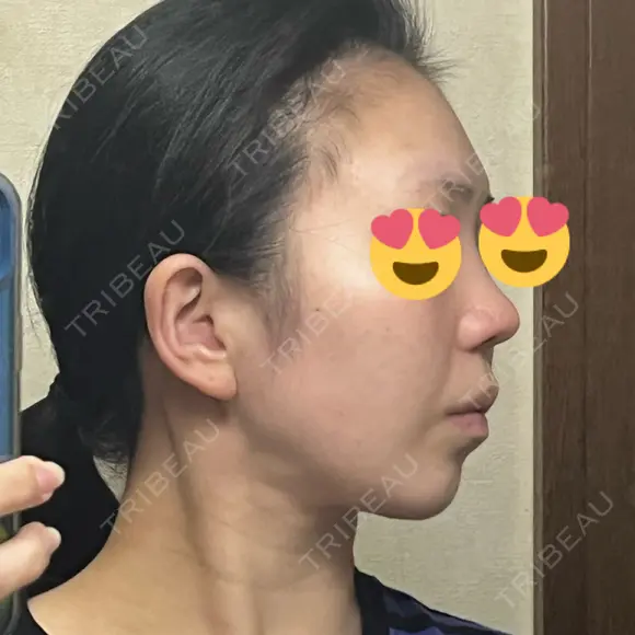 鼻尖形成（切開） / 小鼻縮小（切開） / 脂肪吸引（顔） / 軟骨移植 / 骨切幅寄せ / 鼻尖縮小 / 鼻柱挙上 銀座マイアミ美容外科 DAY 34 メイン用