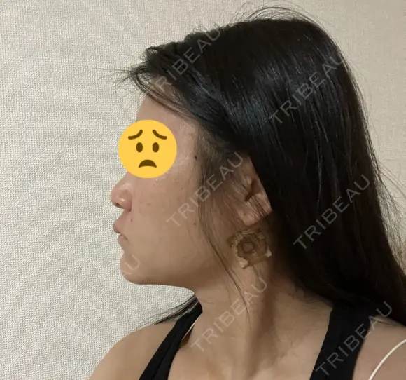 糸リフト / 脂肪吸引注射（顔） / 脂肪注入（輪郭） イテウォンビューティークリニック 名古屋栄院 DAY 1 メイン用