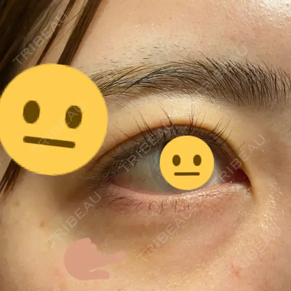 脂肪溶解注射（顔） / シワ取りボトックス / ボトックス（眉間） / ボトックス（目尻） TCB東京中央美容外科 梅田茶屋町院 DAY 8 メイン用