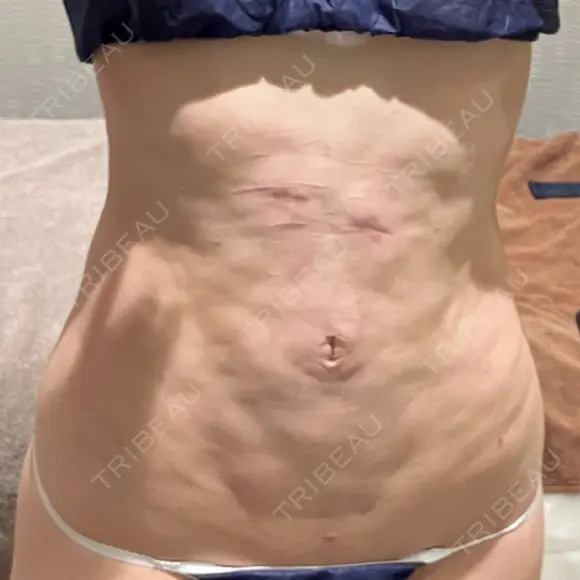 脂肪吸引（二の腕） / 脂肪冷却（お腹） Mods Clinic（モッズクリニック） 東京院 DAY 112 メイン用