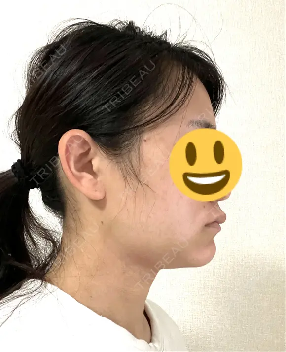 糸リフト / 脂肪吸引注射（顔） / 脂肪注入（輪郭） イテウォンビューティークリニック 名古屋栄院 DAY 3 メイン用