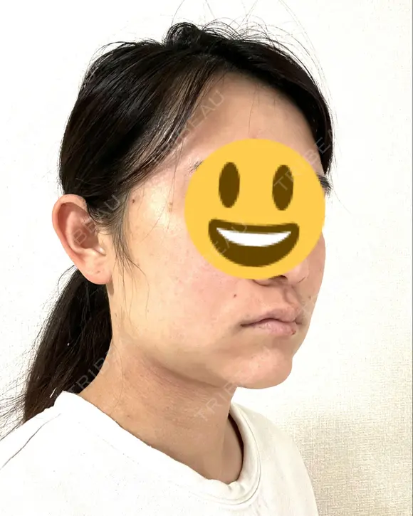 糸リフト / 脂肪吸引注射（顔） / 脂肪注入（輪郭） イテウォンビューティークリニック 名古屋栄院 DAY 3 メイン用