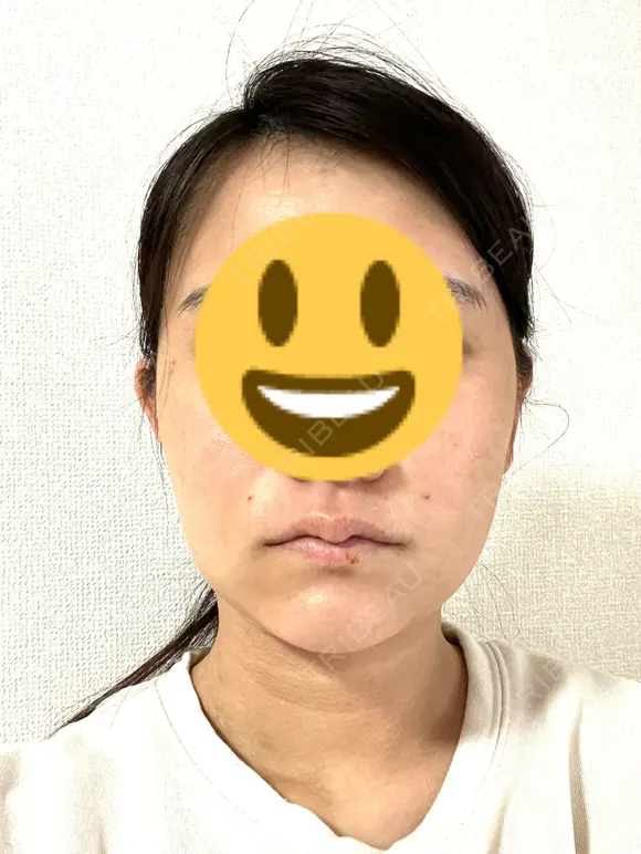 糸リフト / 脂肪吸引注射（顔） / 脂肪注入（輪郭） イテウォンビューティークリニック 名古屋栄院 DAY 3 メイン用