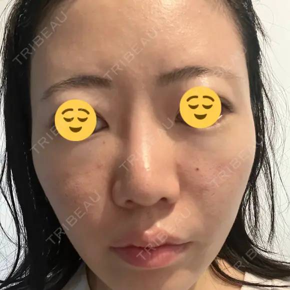 その他（肌） / 美肌レーザー 湘南美容クリニック 静岡院 AFTER メイン用