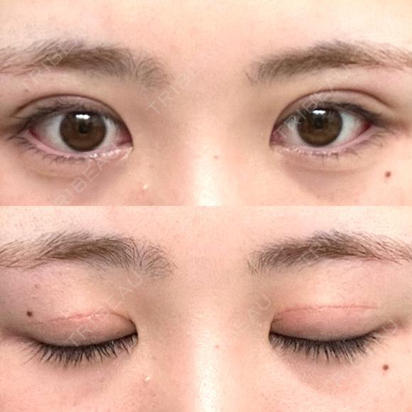二重切開 つだ美容外科クリニック DAY 111 メイン用
