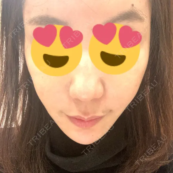 糸リフト / 脂肪吸引（顔） / ボトックス（エラ・小顔） / ヒアルロン酸注入（頬） Tokyo Tensei Clinic 新宿院 AFTER メイン用