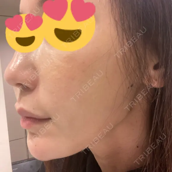 糸リフト / 脂肪吸引（顔） / ボトックス（エラ・小顔） / ヒアルロン酸注入（頬） Tokyo Tensei Clinic 新宿院 DAY 54 メイン用